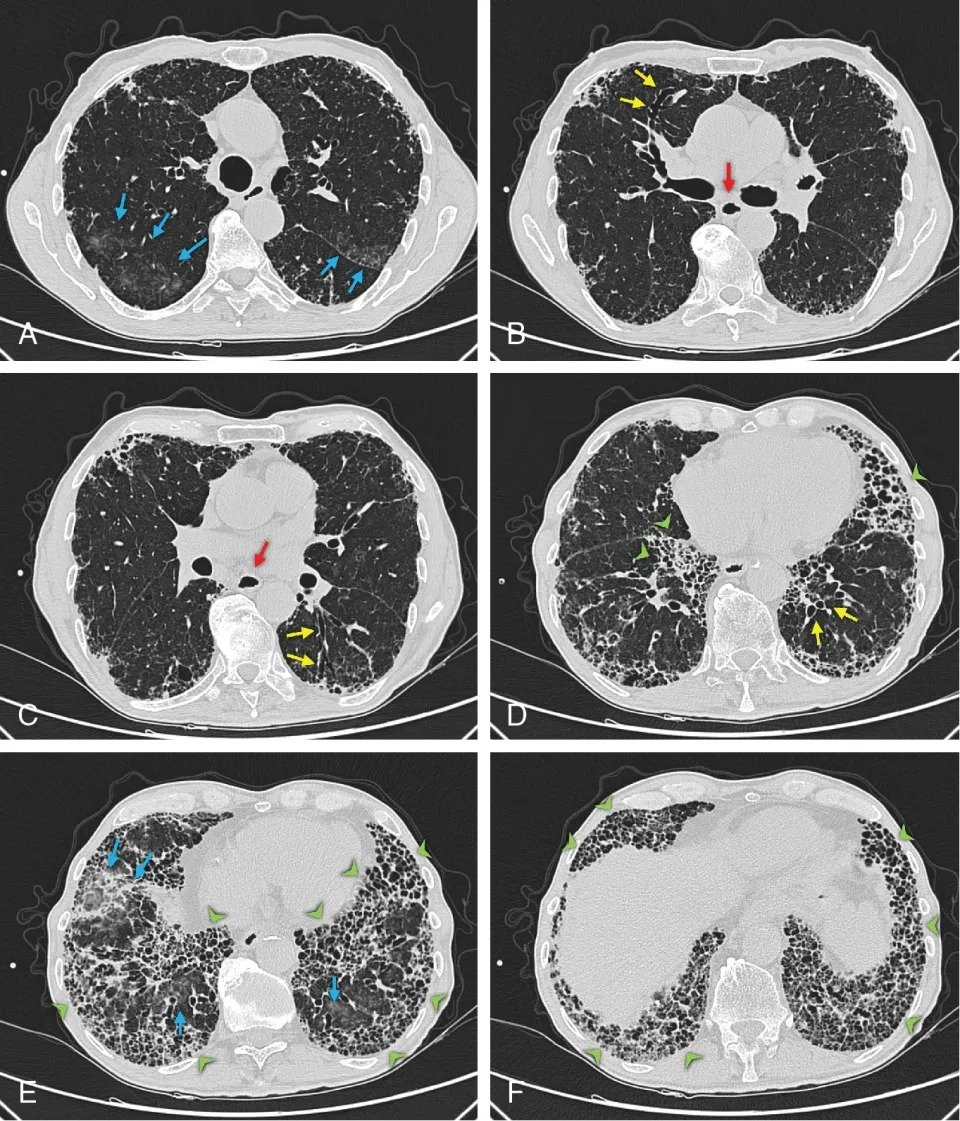 Chest imaging illustrating interstitial lung disease