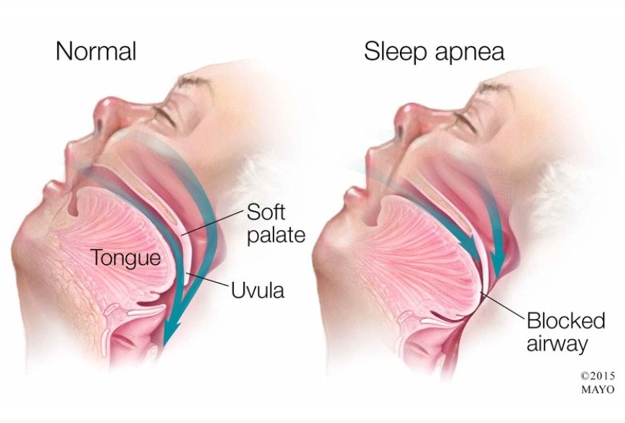 Illustration of obstructive sleep apnea