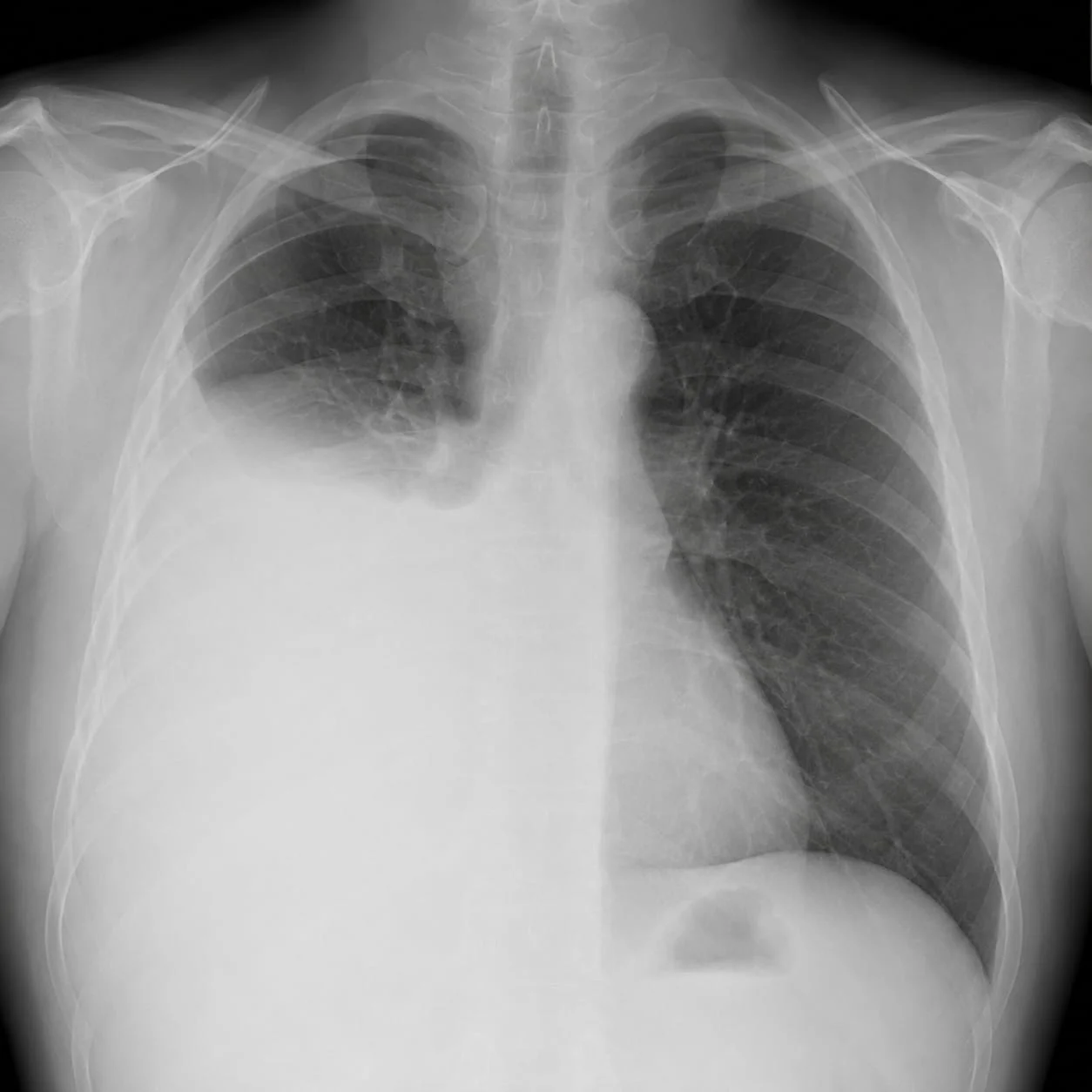 Chest X-ray image illustrating pleural effusion