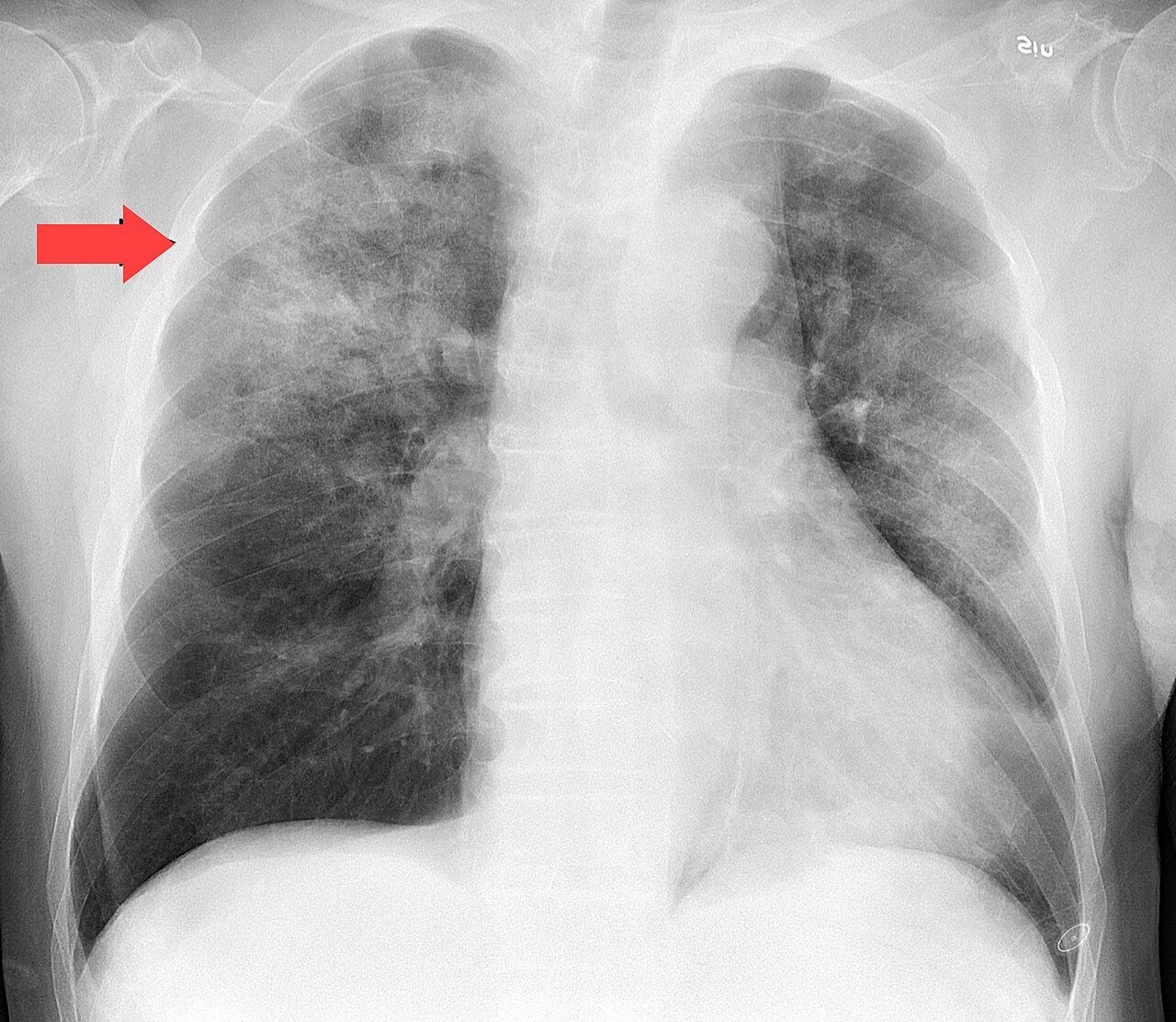 Chest X-ray image illustrating pneumonia