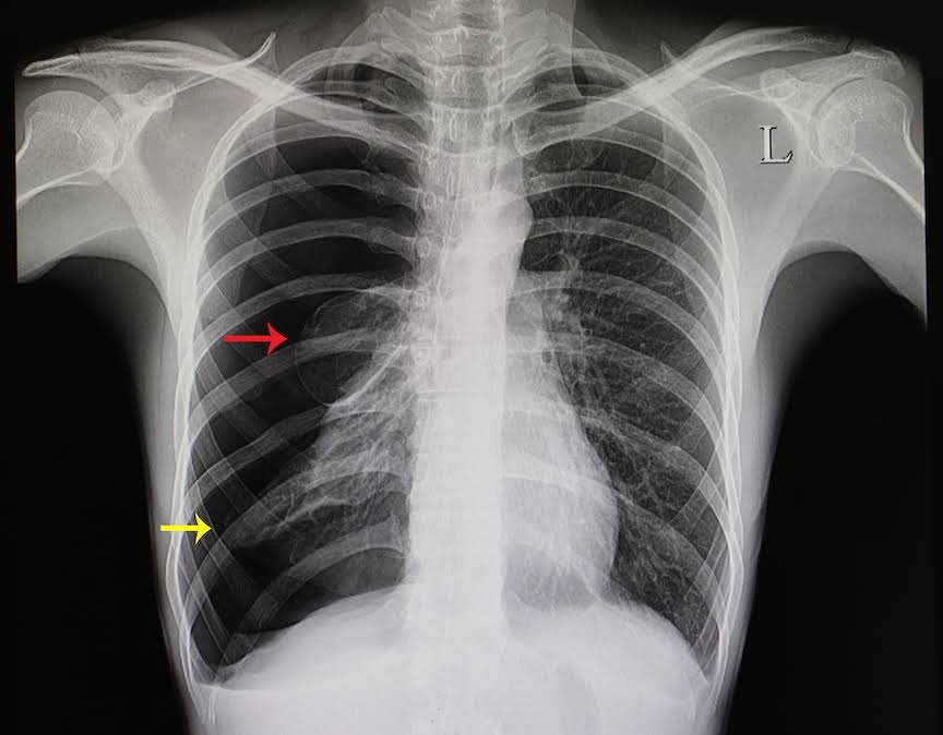 Chest X-ray illustrating pneumothorax