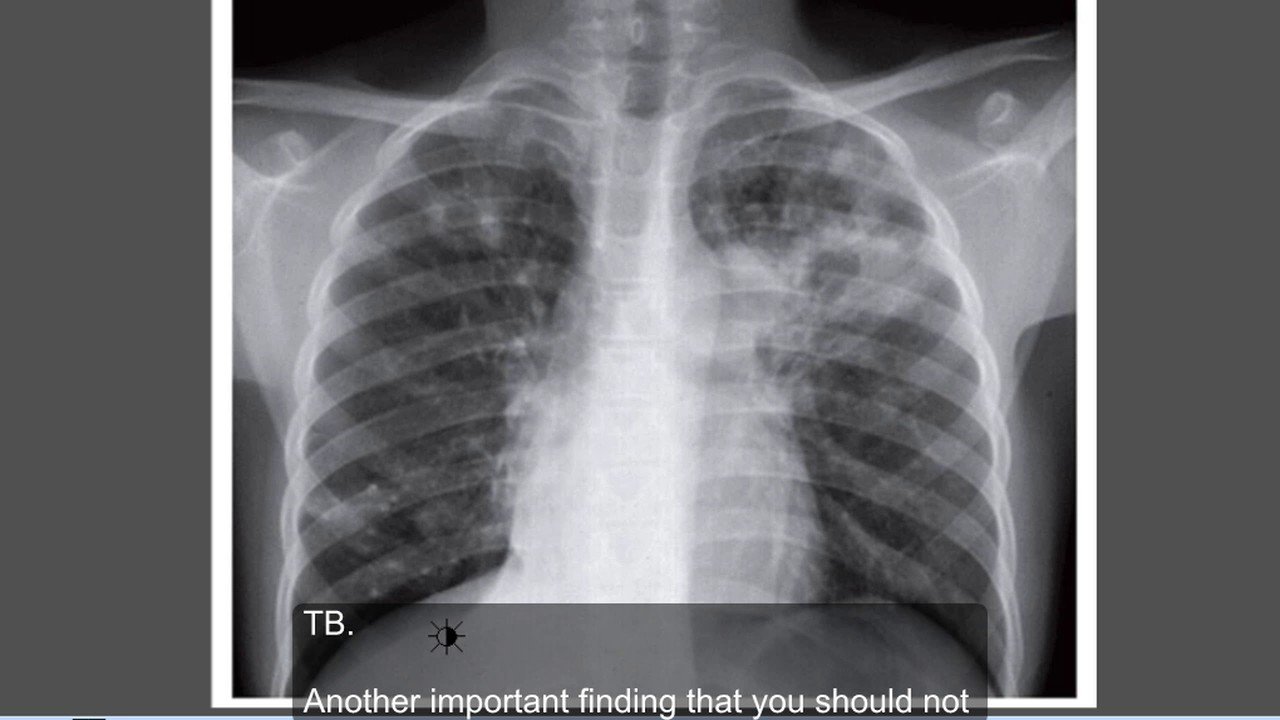 Chest X-ray image illustrating pulmonary tuberculosis